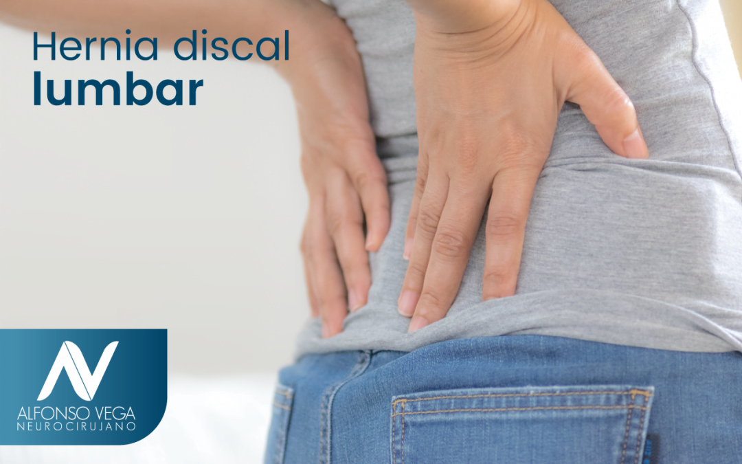 ¿Qué es una hernia discal lumbar?