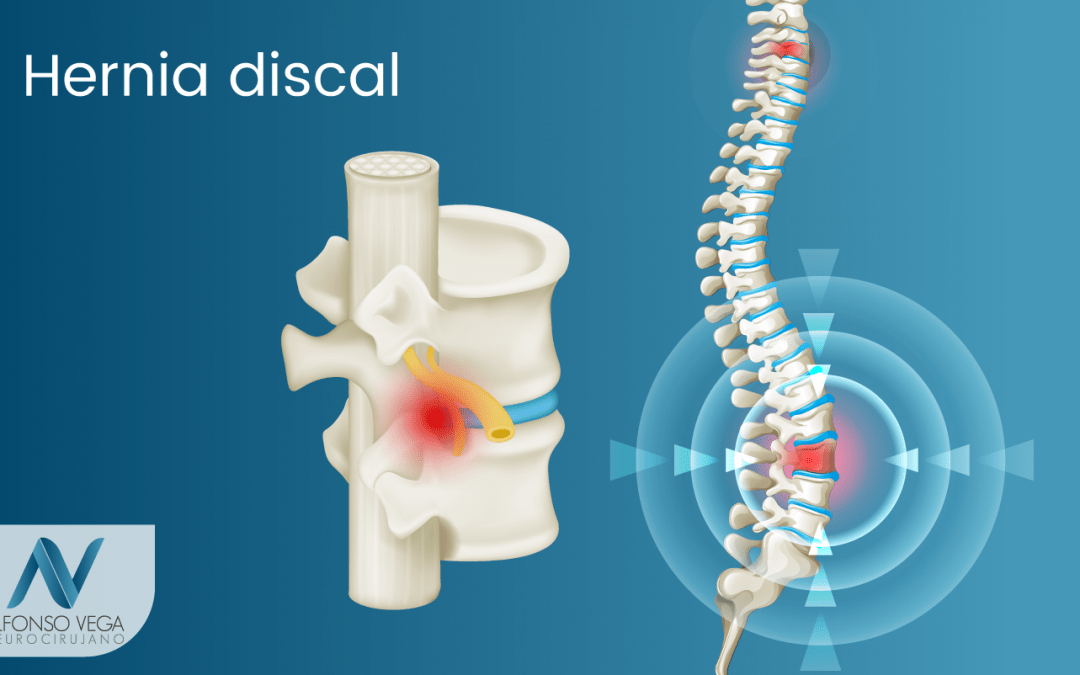 ¿Qué es una hernia discal? ¿Cuáles son sus causas?