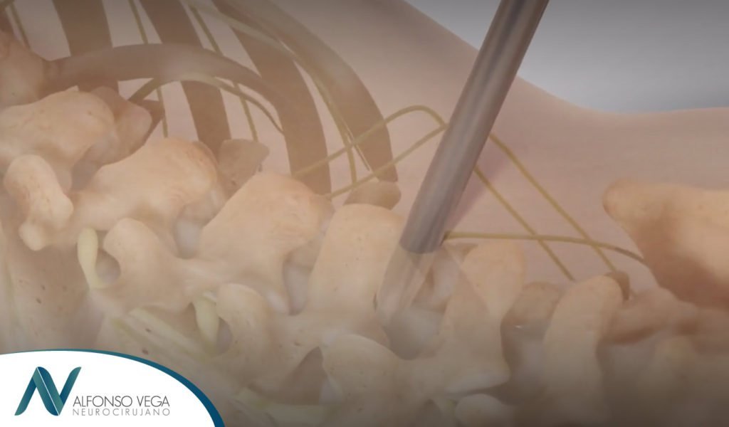 ¿Qué es una microdiscectomía?