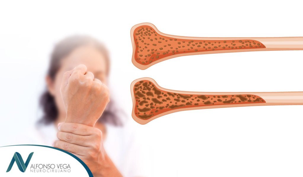 Osteoporosis: causas, síntomas y tratamiento