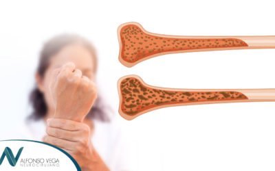 Osteoporosis: causas, síntomas y tratamiento