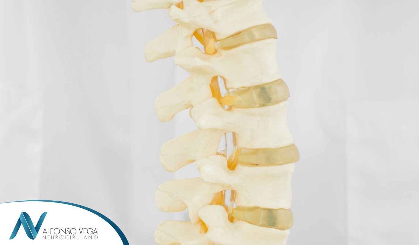 ¿Qué es una vertebroplastia?