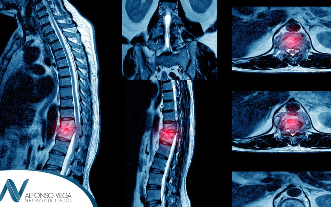 Lesión de médula espinal