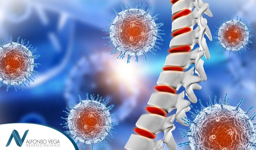Infección vertebral: síntomas, causas y tratamiento