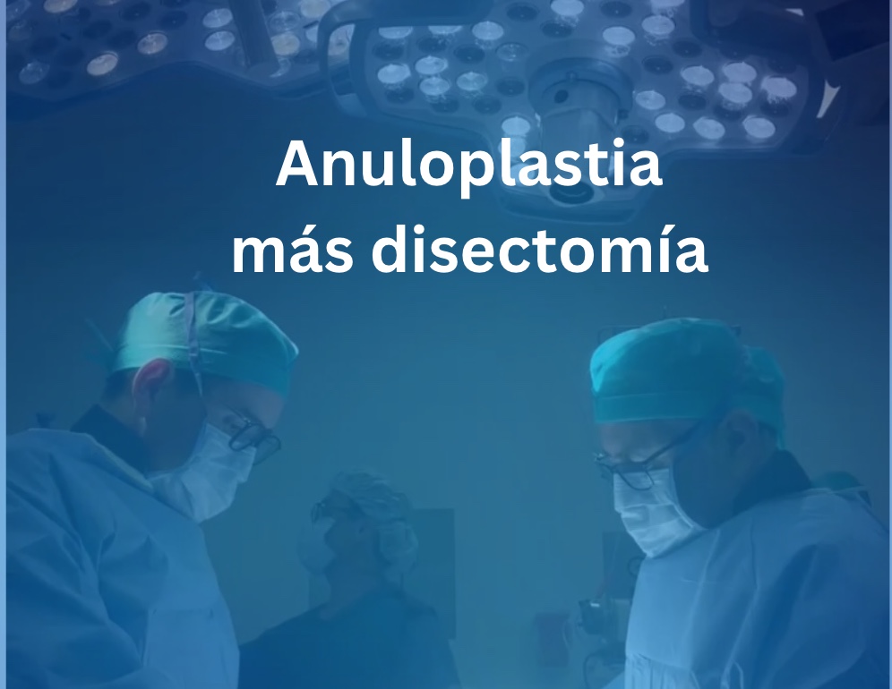 Anuloplastia más disectomía: Una combinación quirúrgica para el tratamiento de la hernia discal