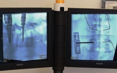 Cirugía Mínimamente Invasiva: Una revolución en la neurocirugía moderna